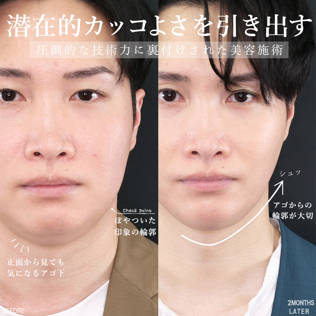 TAC式 ツヤ肌コラーゲンリフト®/TAC式 ショッピングリフト/バッカルファット除去の症例写真 施術前後 