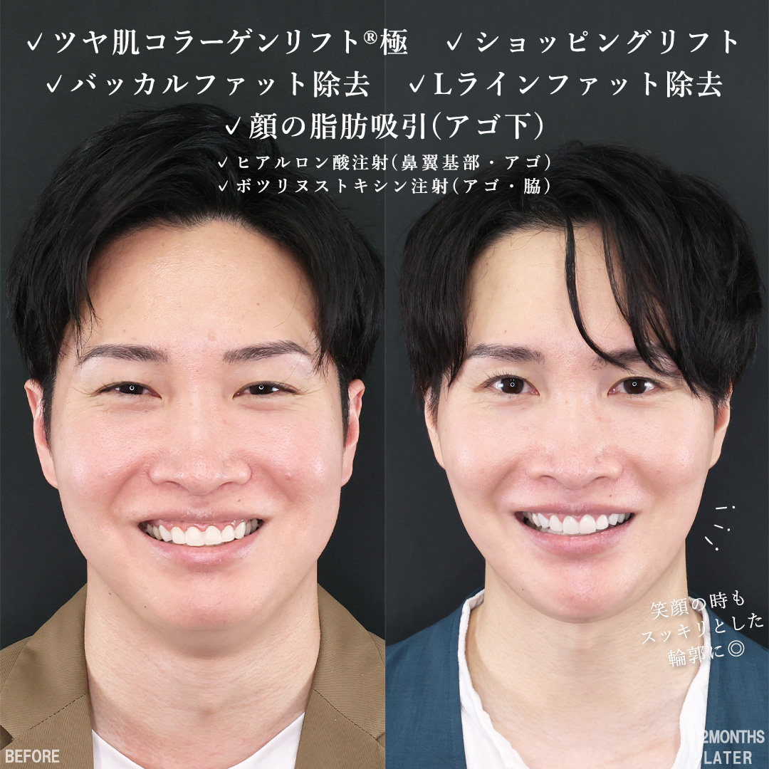 TAC式 ツヤ肌コラーゲンリフト®/TAC式 ショッピングリフト/バッカルファット除去の症例写真 施術前後 