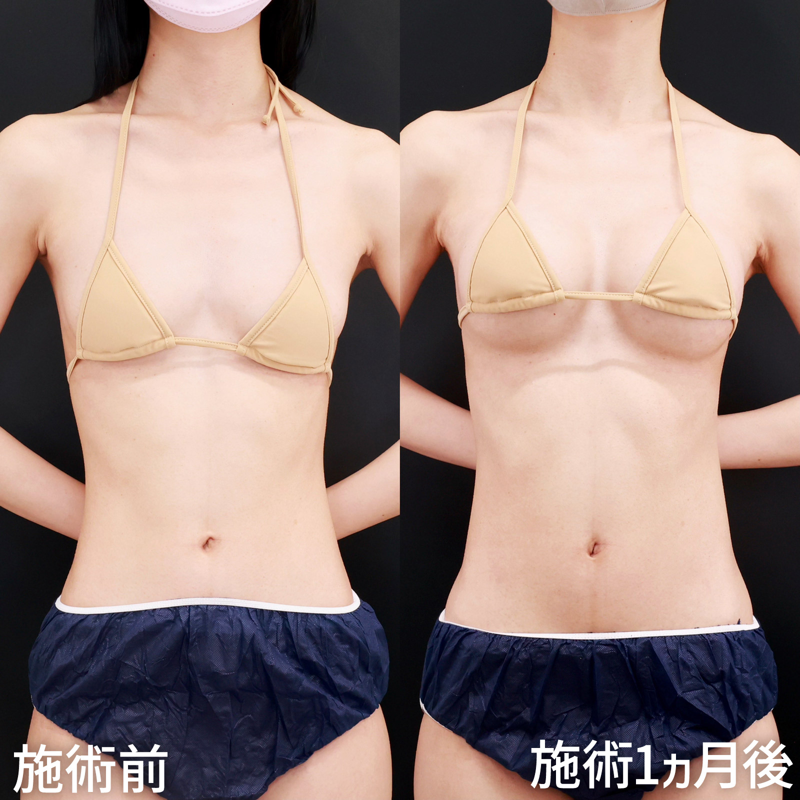 シリコンバッグ豊胸（人工乳腺バッグ）の症例写真 施術前後 