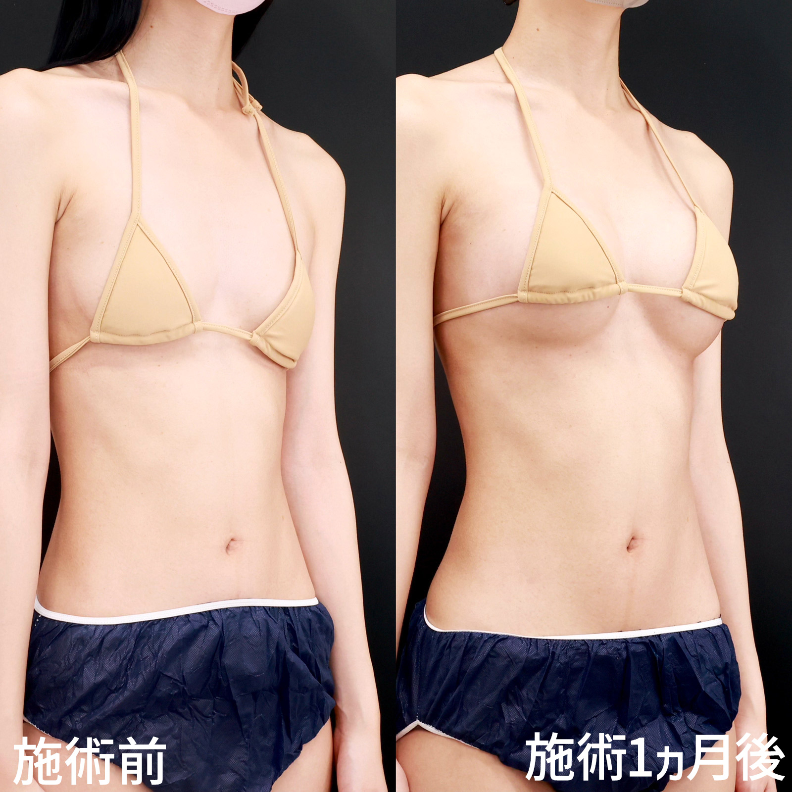 シリコンバッグ豊胸（人工乳腺バッグ）の症例写真 施術前後 
