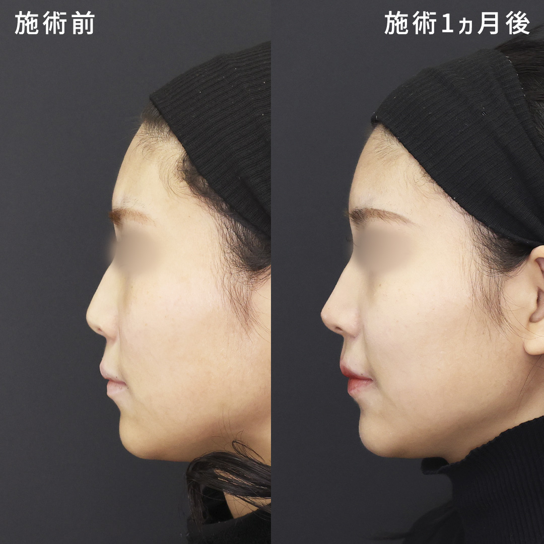 鼻尖形成・鼻尖縮小/ヴィーナスノーズ（切らない鼻中隔延長術）の症例写真 施術前後 