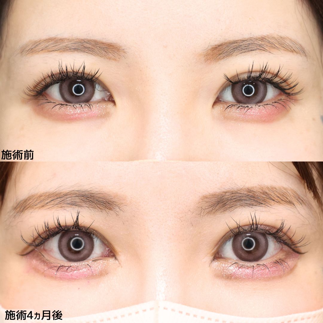 目頭切開術/目尻切開術の症例写真 施術前後 