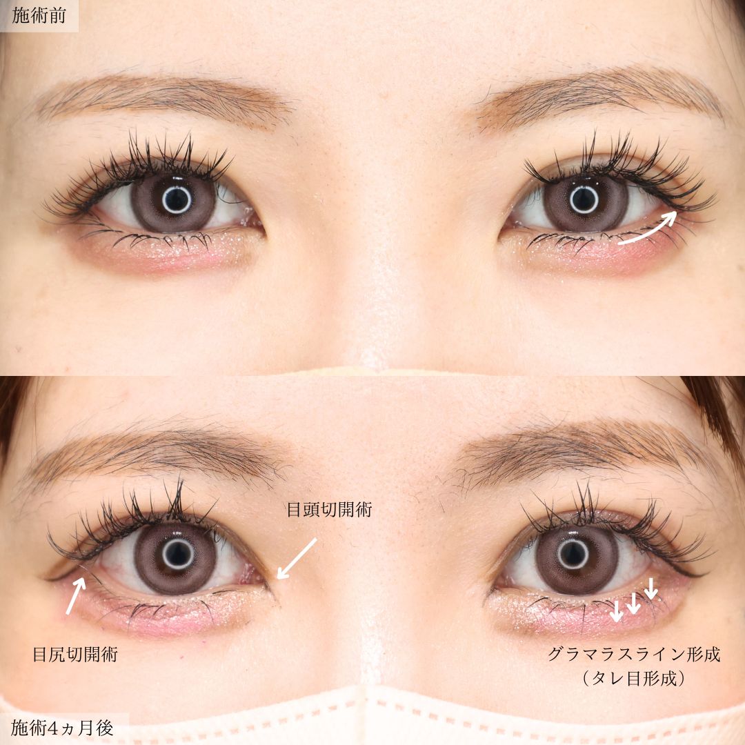 目頭切開術/目尻切開術の症例写真 施術前後 