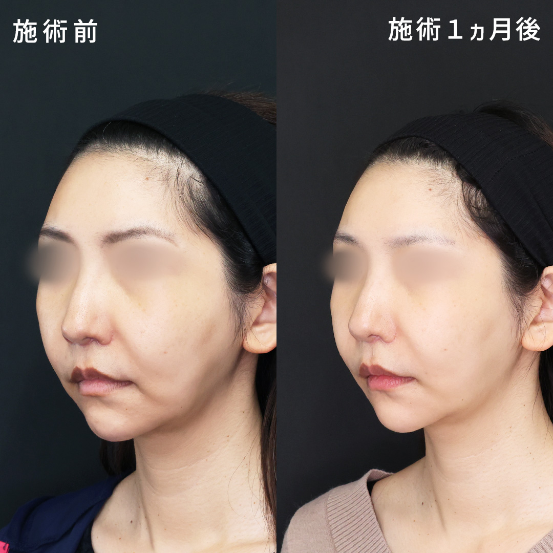 TAC式 ツヤ肌コラーゲンリフト®/TAC式 ショッピングリフト/ジョールファット除去の症例写真 施術前後 