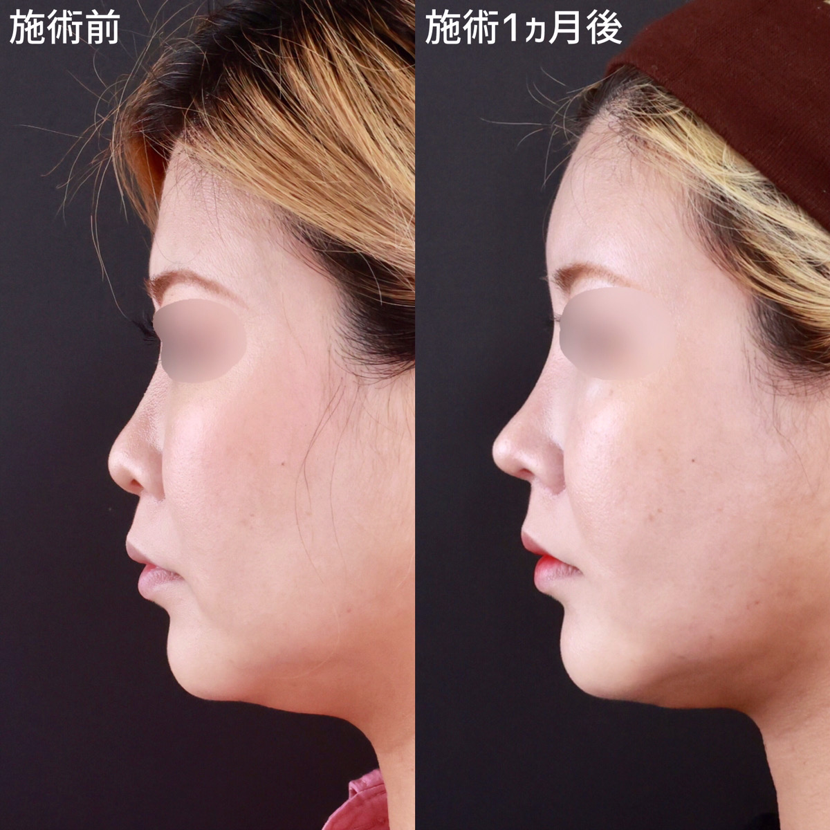 TAC式 ツヤ肌コラーゲンリフト®/顎下の脂肪吸引/鼻尖形成・鼻尖縮小の症例写真 施術前後 