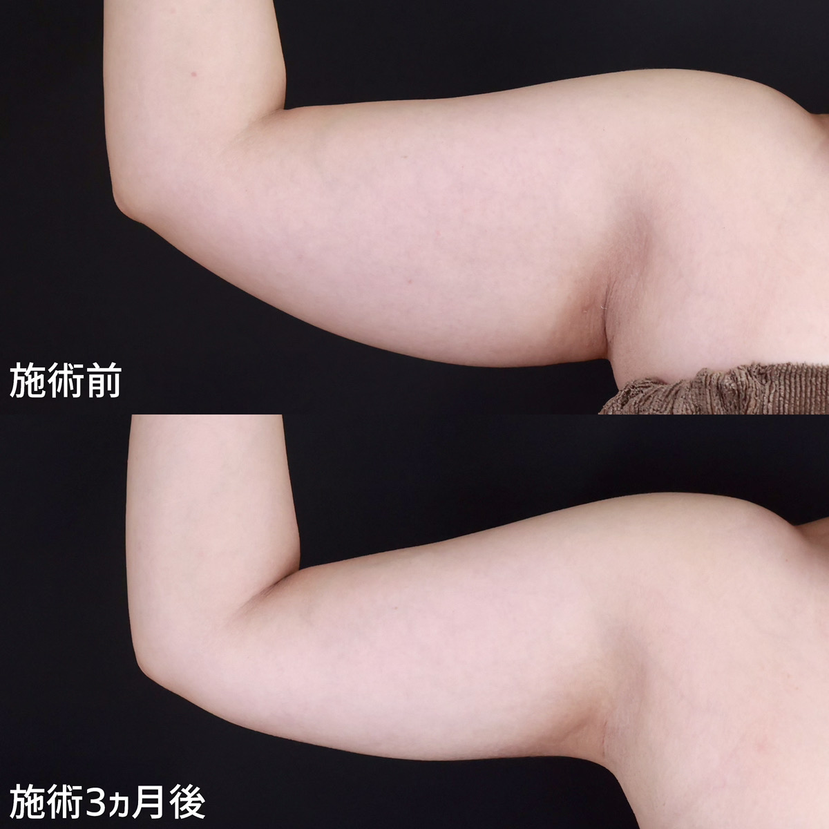 体の脂肪吸引の症例写真 施術前後 
