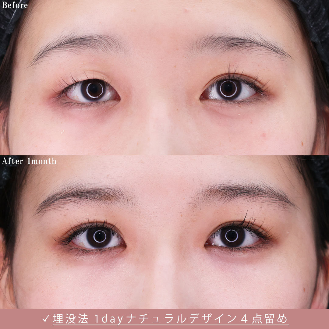二重埋没法/片目二重術（片目だけ整形したい方）の症例写真 施術前後 