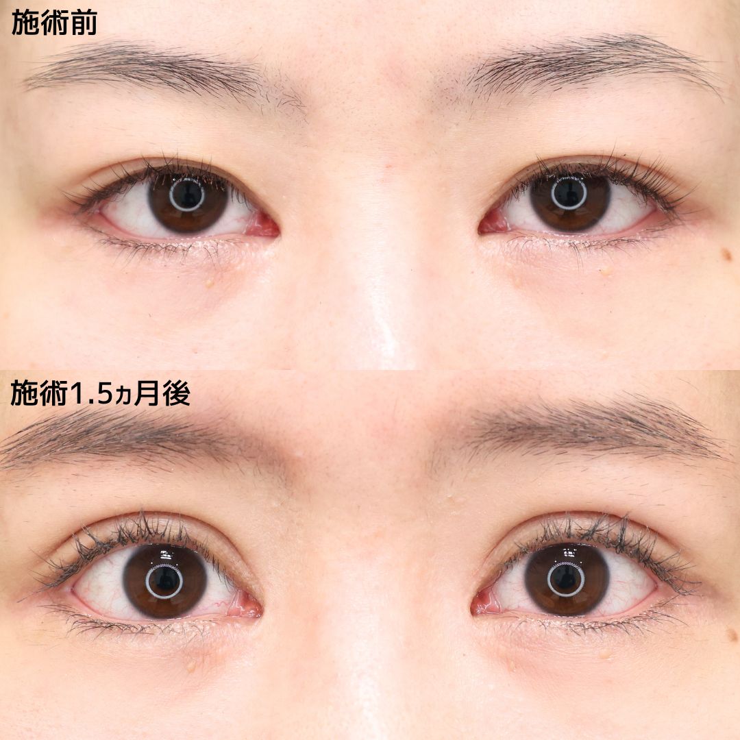 二重埋没法の症例写真 施術前後 