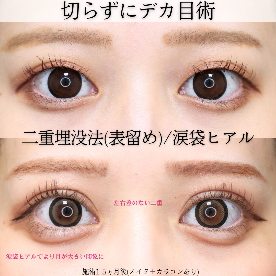 二重埋没法/涙袋形成（ヒアルロン酸注射）の症例写真 施術前後 