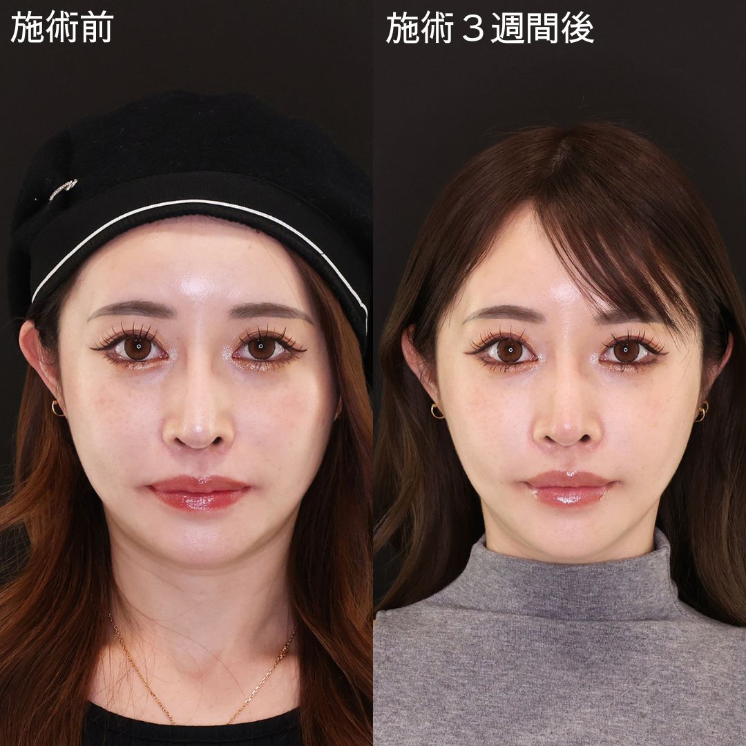 TAC式 ツヤ肌コラーゲンリフト®/ほうれい線のヒアルロン酸注射/眉間のしわ取りボトックス注射の症例写真 施術前後 