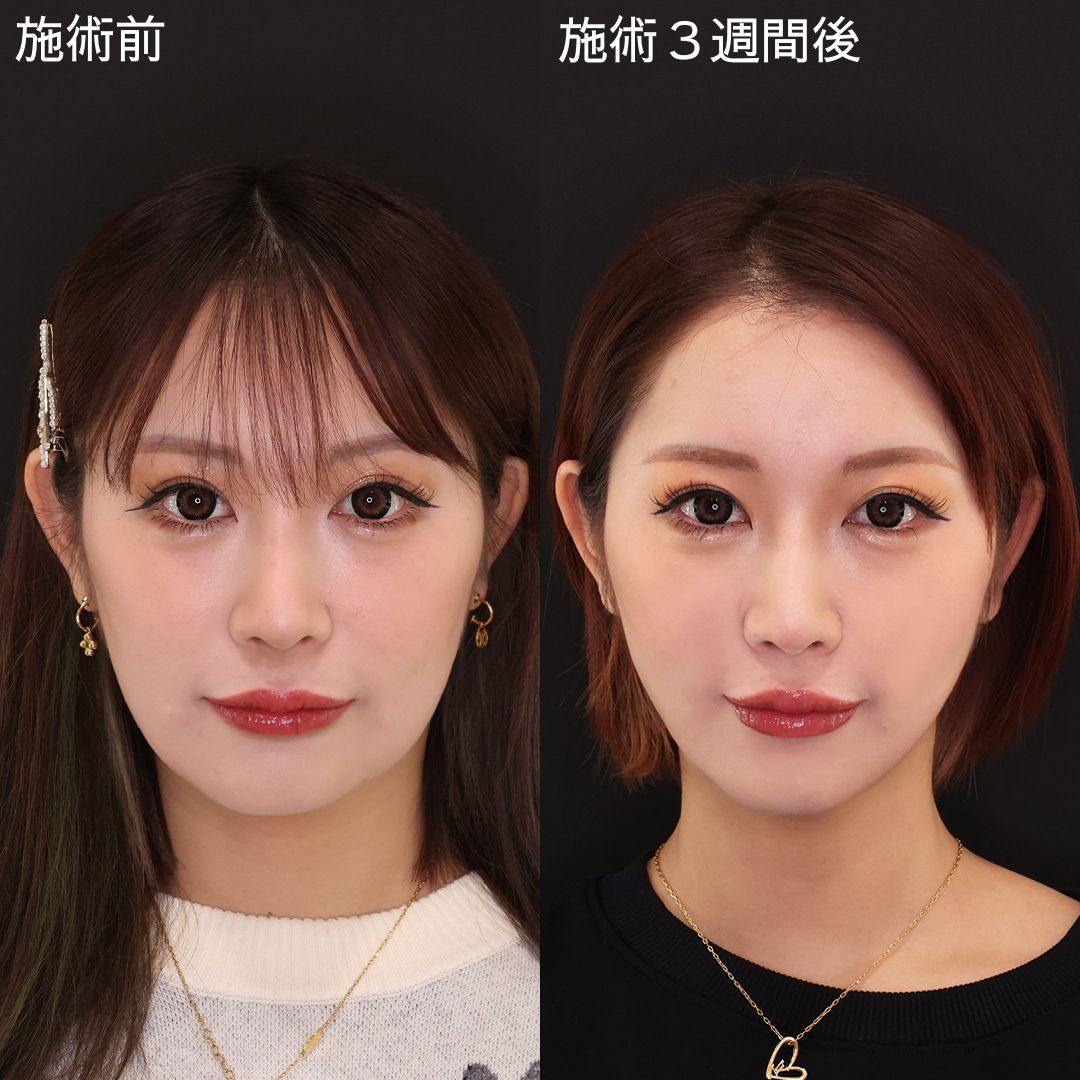 TAC式 ツヤ肌コラーゲンリフト®/ほうれい線のヒアルロン酸注射の症例写真 施術前後 