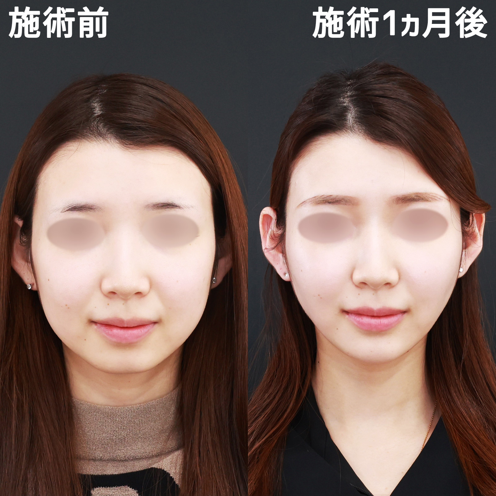 【小顔複合施術】下膨れ顔もパーフェクトフェイスラインでスッキリ解消！
