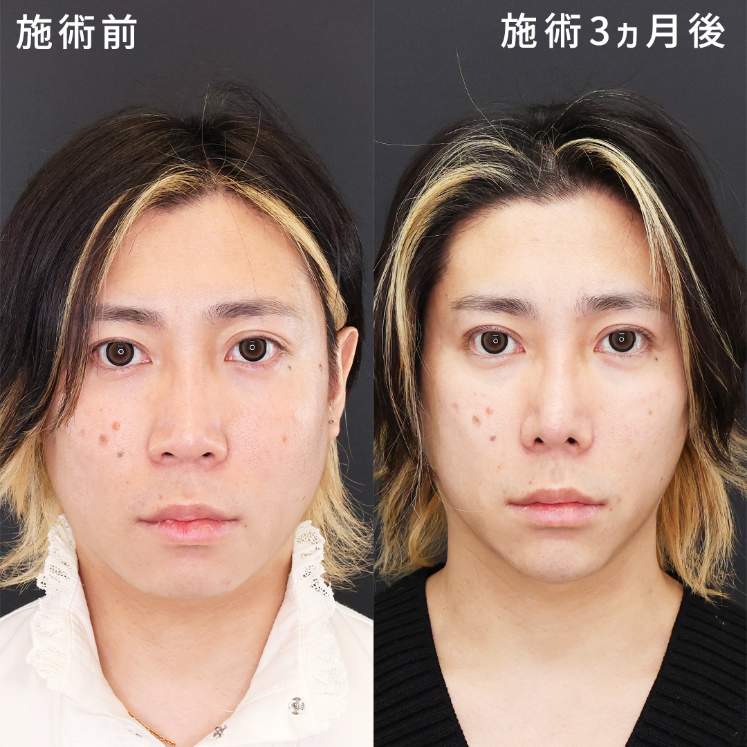 二重埋没法/TAC式 ツヤ肌コラーゲンリフト®/ジョールファット除去の症例写真 施術前後 