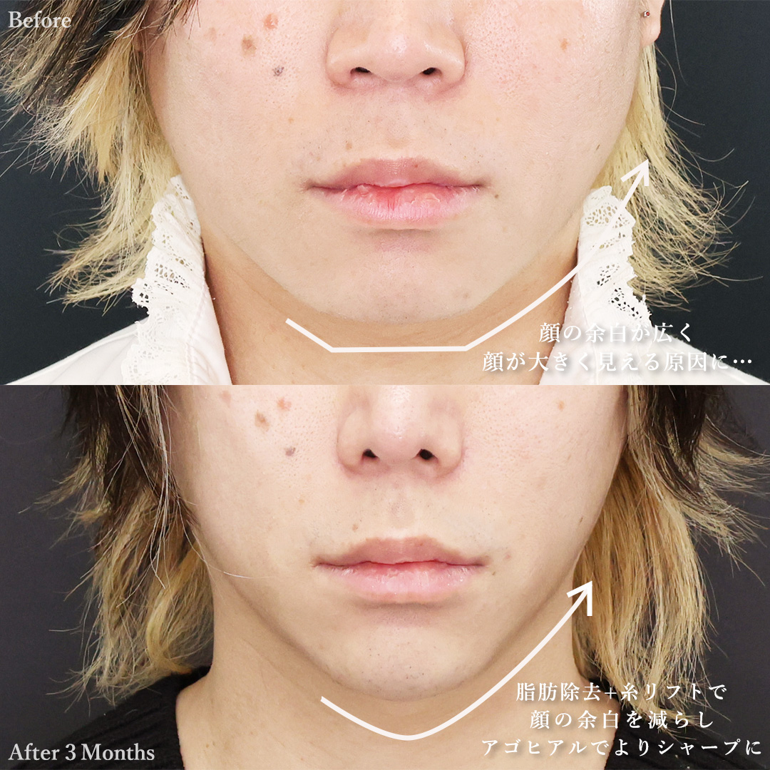 二重埋没法/TAC式 ツヤ肌コラーゲンリフト®/ジョールファット除去の症例写真 施術前後 