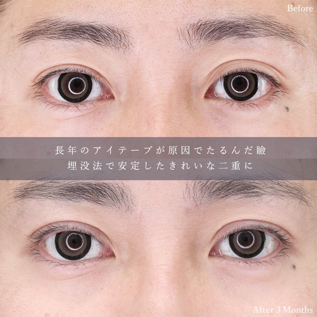 二重埋没法/TAC式 ツヤ肌コラーゲンリフト®/ジョールファット除去の症例写真 施術前後 