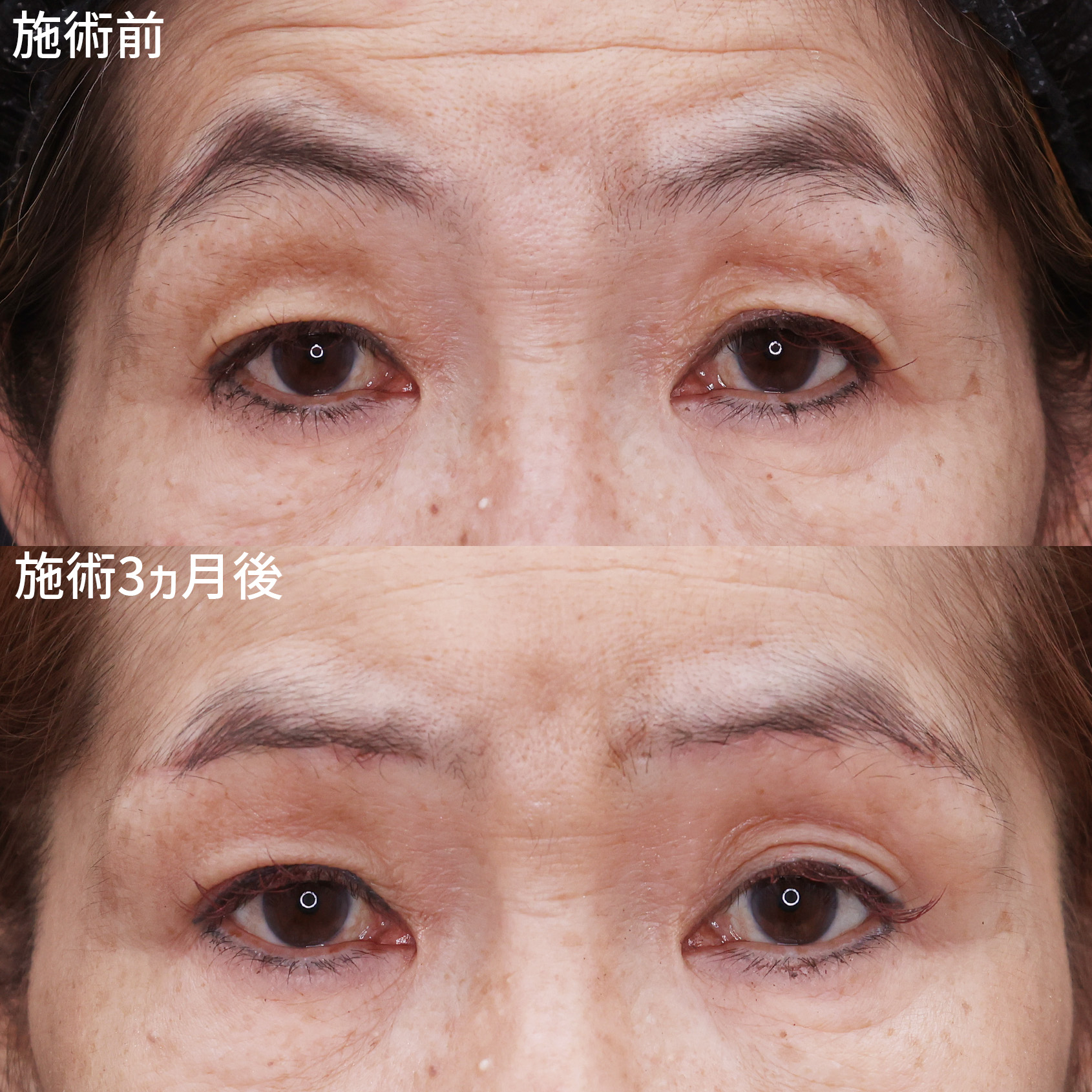 眉毛下切開術の症例写真 施術前後 