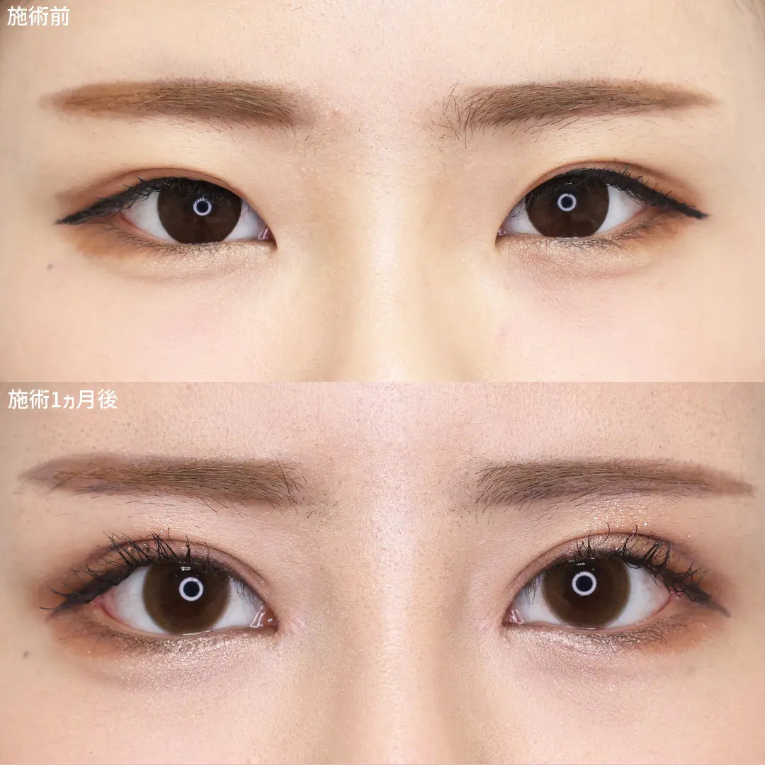 二重切開（全切開法）/目尻切開術/目頭切開術の症例写真 施術前後 