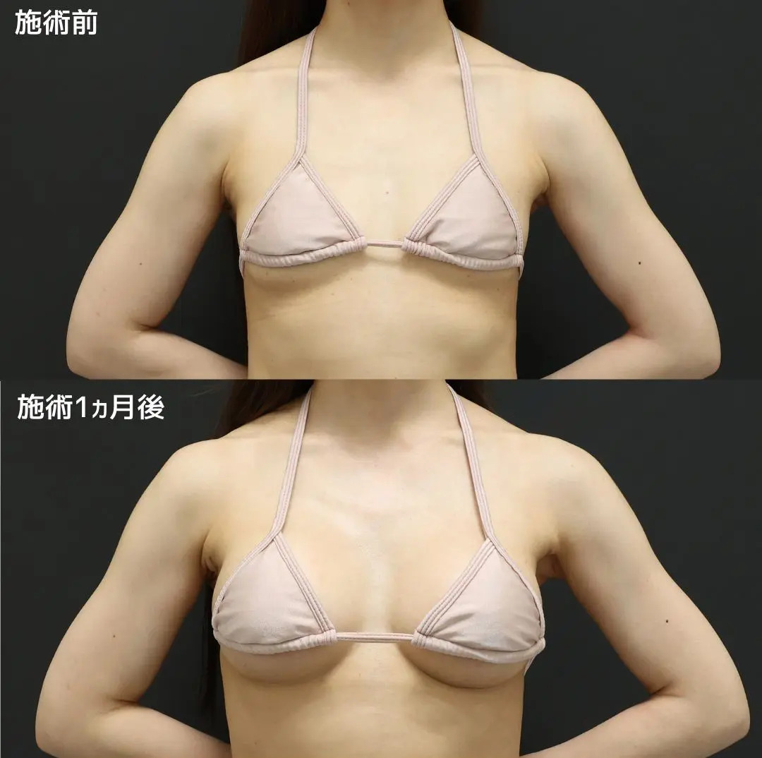 シリコンバッグ豊胸（人工乳腺バッグ）の症例写真 施術前後 
