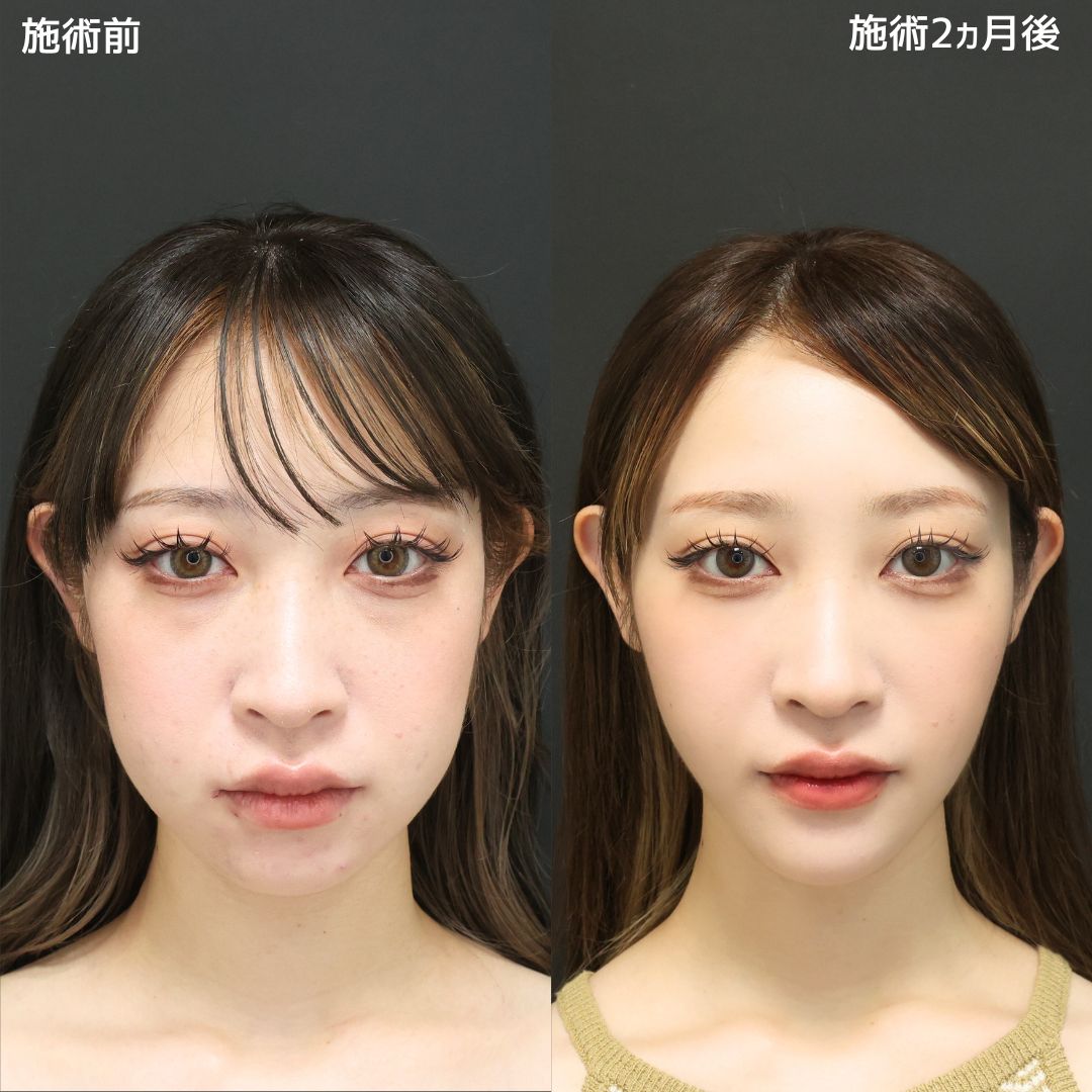 《小顔整形》自分史上最強に可愛くなりました