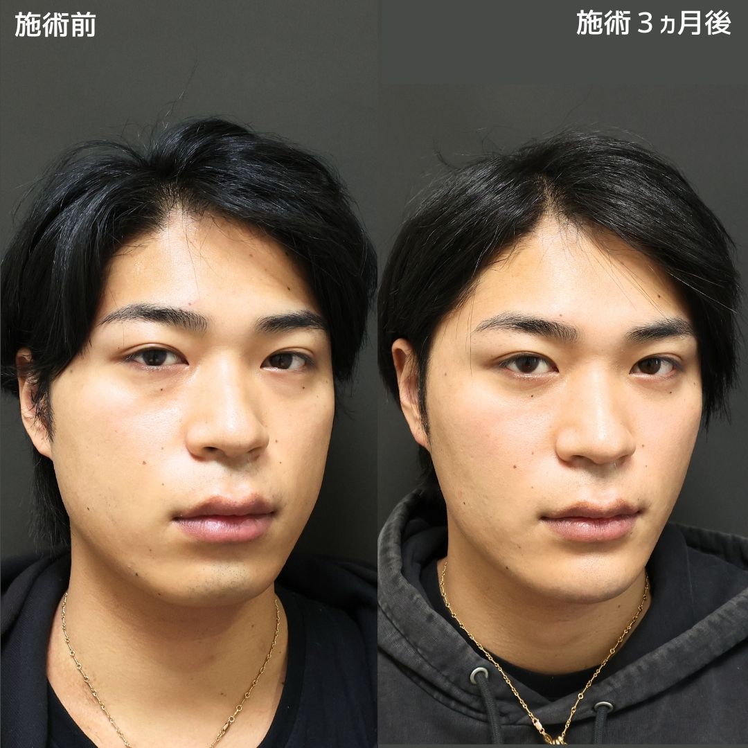 TAC式 ツヤ肌コラーゲンリフト®/バッカルファット除去/ジョールファット除去の症例写真 施術前後 
