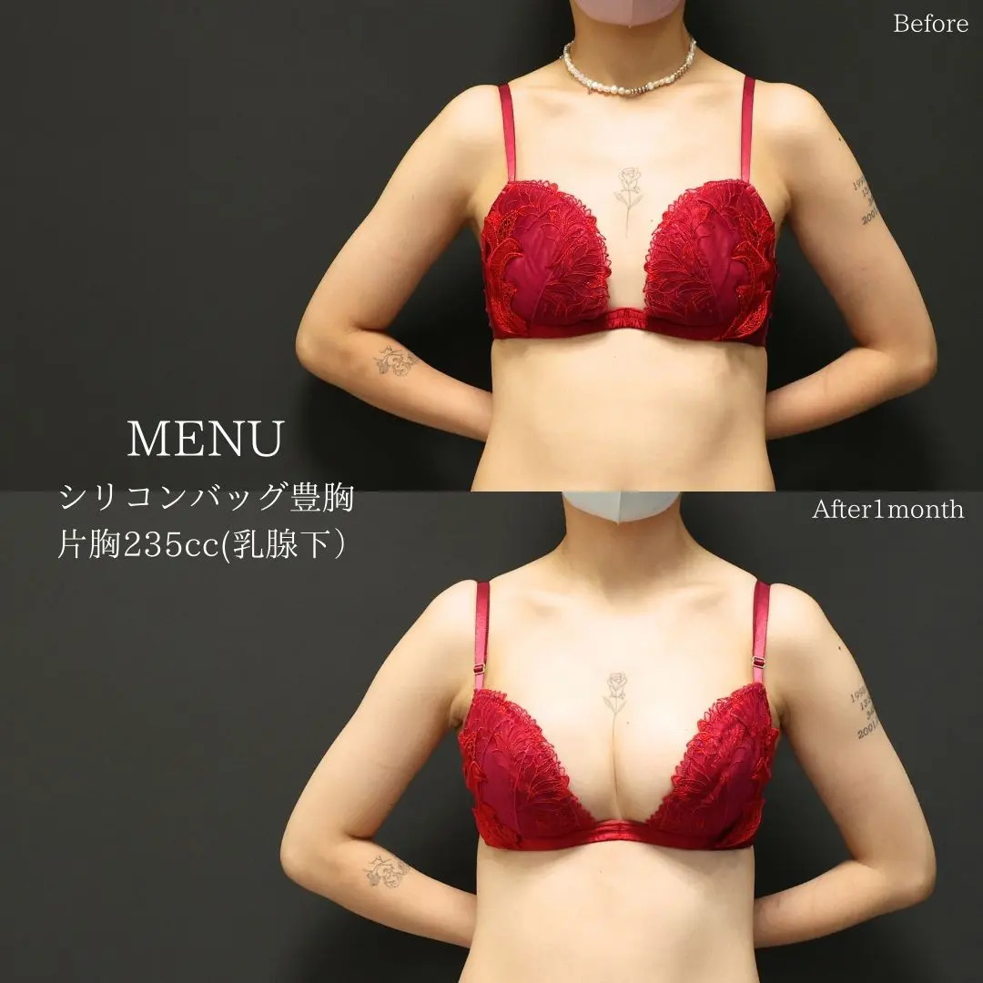 シリコンバッグ豊胸（人工乳腺バッグ）の症例写真 施術前後 