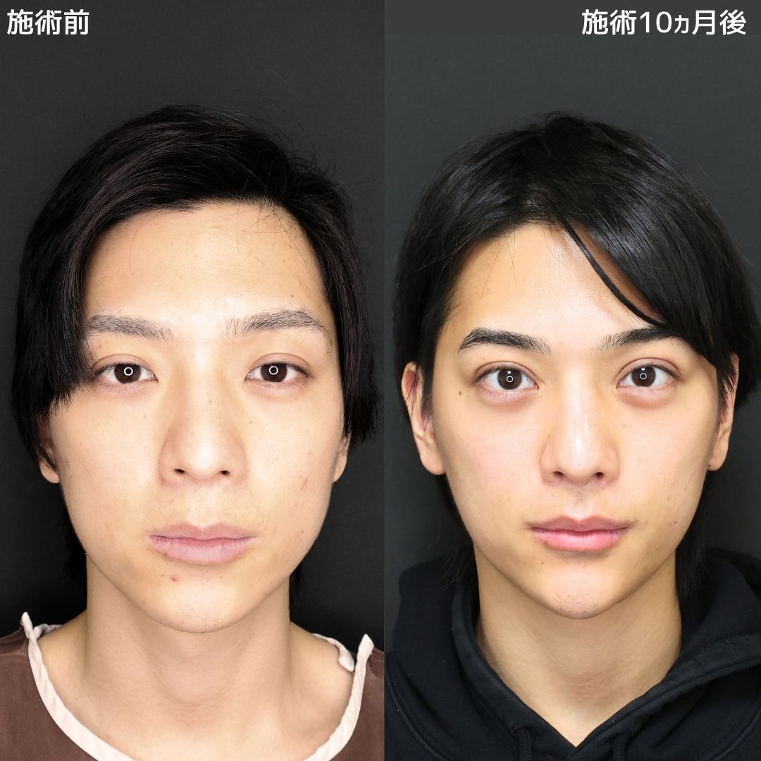 TAC式 ツヤ肌コラーゲンリフト®/下眼瞼脱脂術（目の下のたるみ取り・目の下の脂肪ふくらみ取り）/目の下のヒアルロン酸注射の症例写真 施術前後 