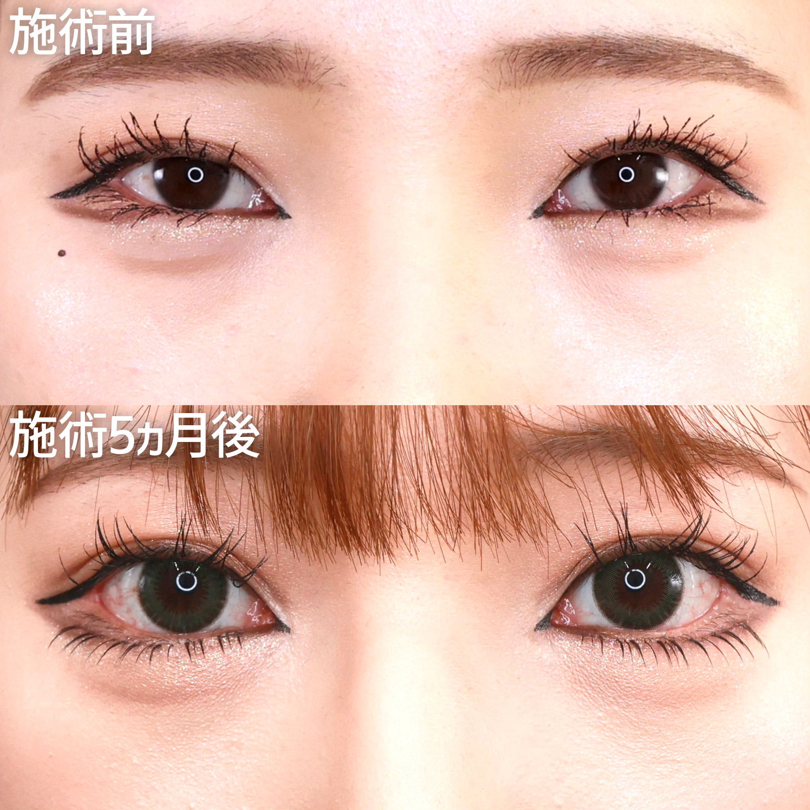 グラマラスライン（タレ目形成）/目尻切開術/目尻靭帯移動術の症例写真 施術前後 