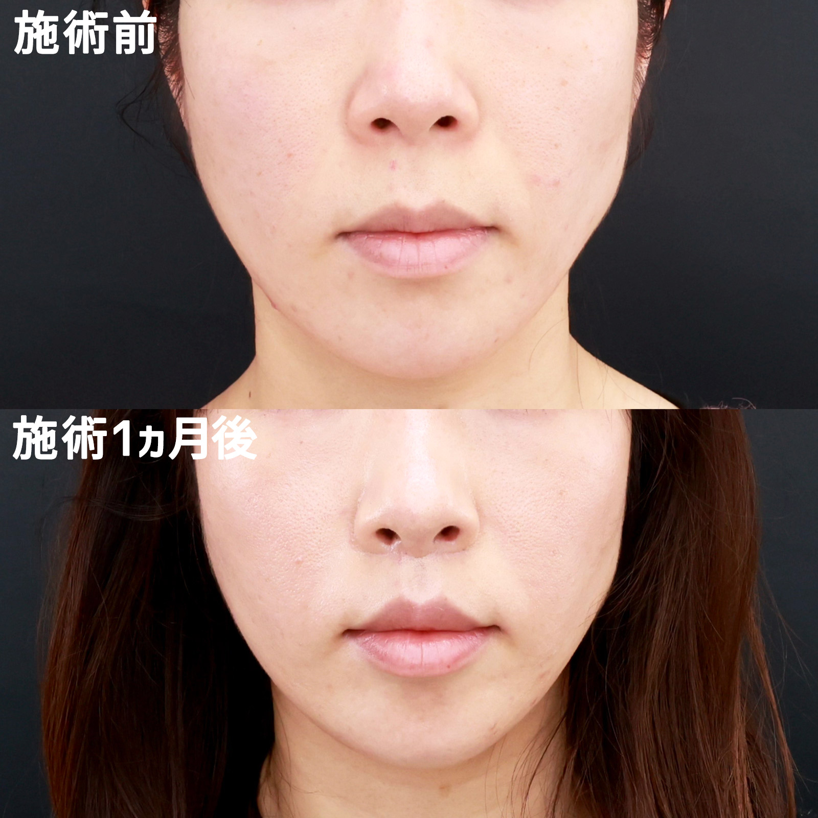 人中短縮術(リップリフト)・外側人中短縮術の症例写真 施術前後 