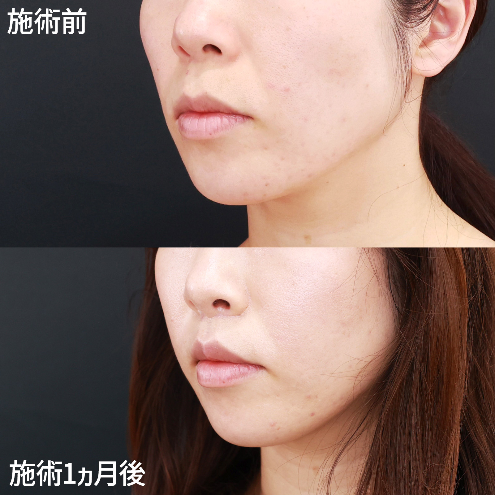 人中短縮術(リップリフト)・外側人中短縮術の症例写真 施術前後 