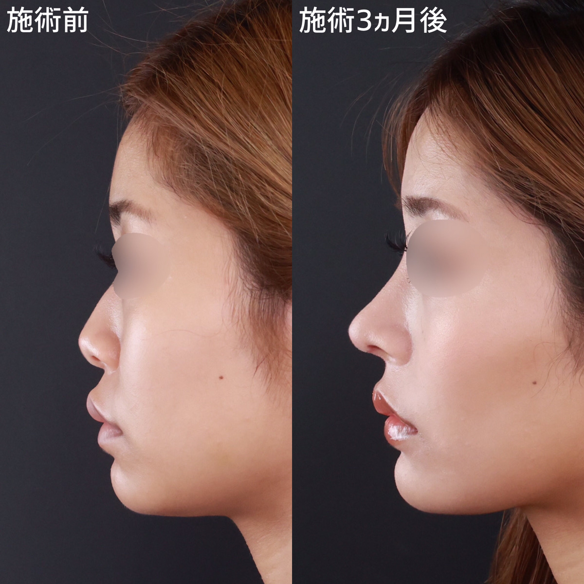 鼻尖形成・鼻尖縮小/鼻先軟骨移植/鼻中隔延長術の症例写真 施術前後 