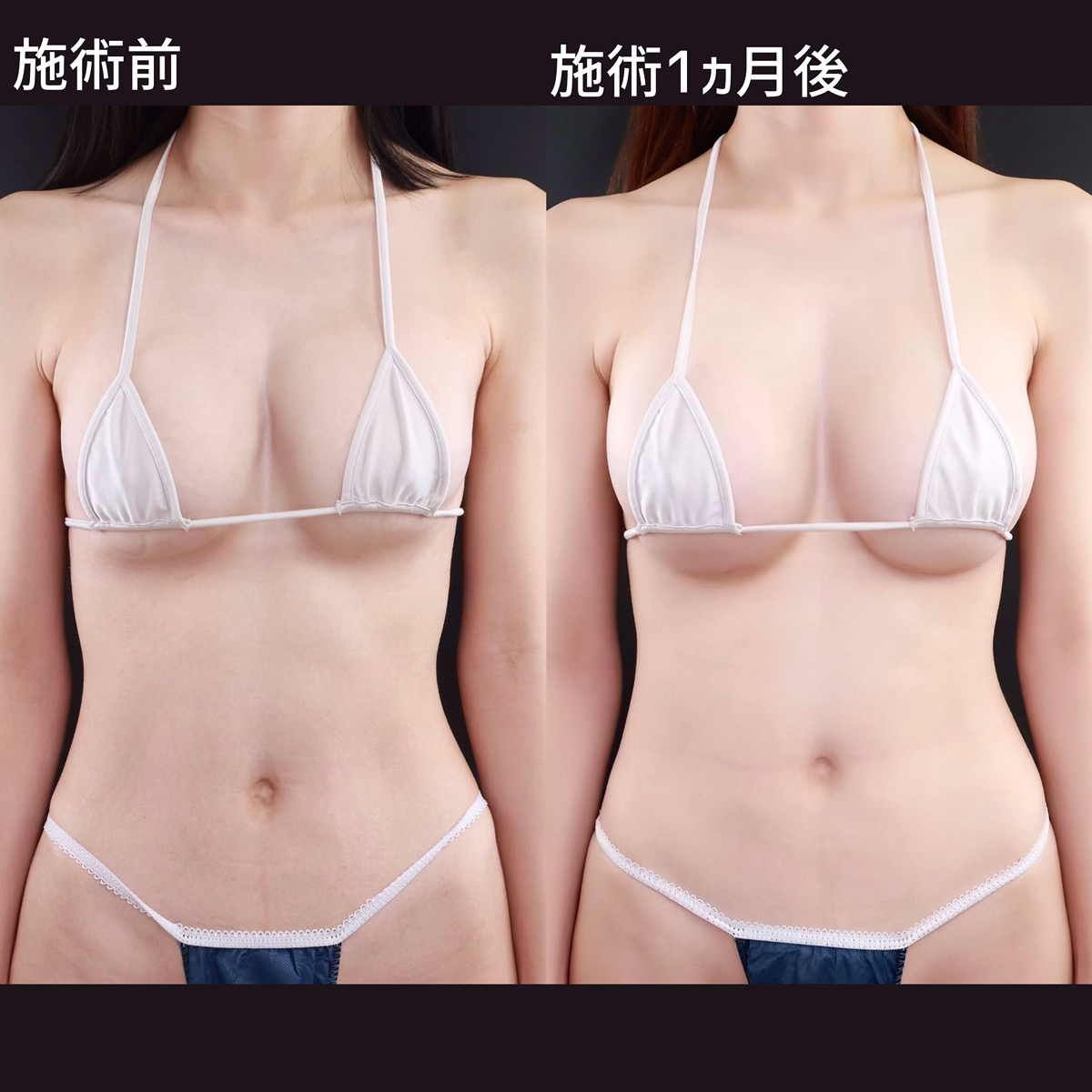 【シリコンバッグ豊胸】他院修正で形が整い、美バストへ！