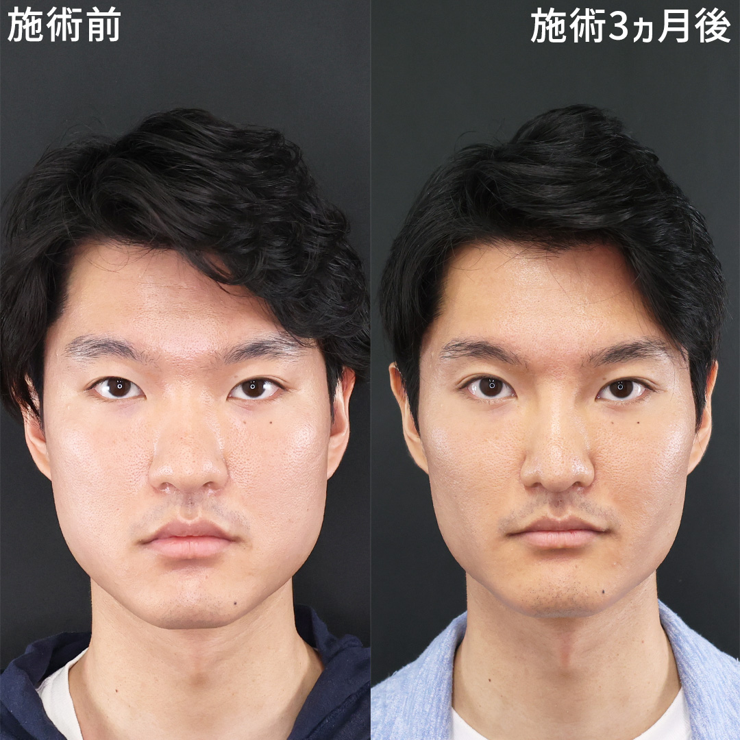 TAC式 ツヤ肌コラーゲンリフト®/ジョールファット除去/バッカルファット除去の症例写真 施術前後 