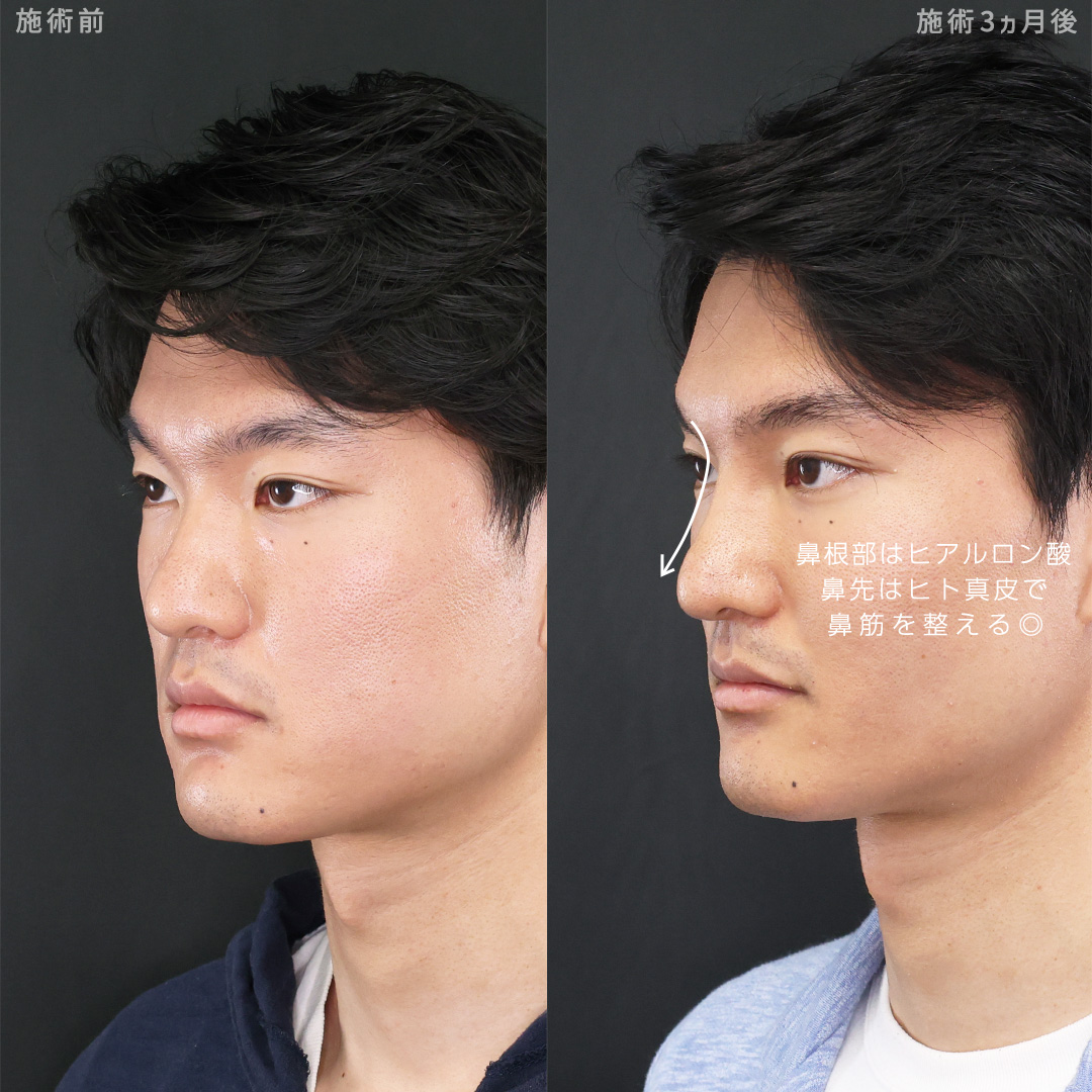 TAC式 ツヤ肌コラーゲンリフト®/ジョールファット除去/バッカルファット除去の症例写真 施術前後 