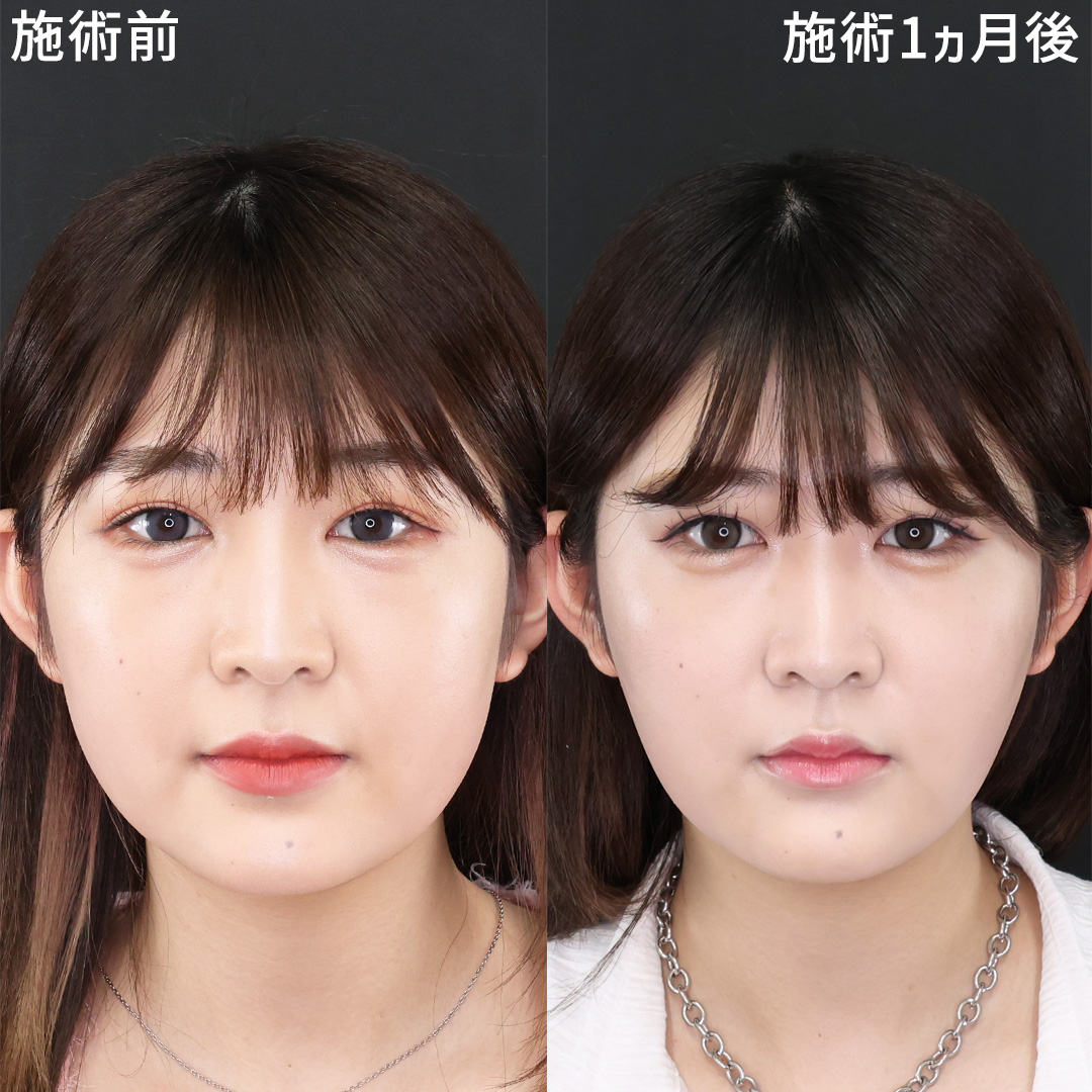 TAC式 ツヤ肌コラーゲンリフト®/ジョールファット除去/Lラインファット除去（エラ下脂肪除去）の症例写真 施術前後 