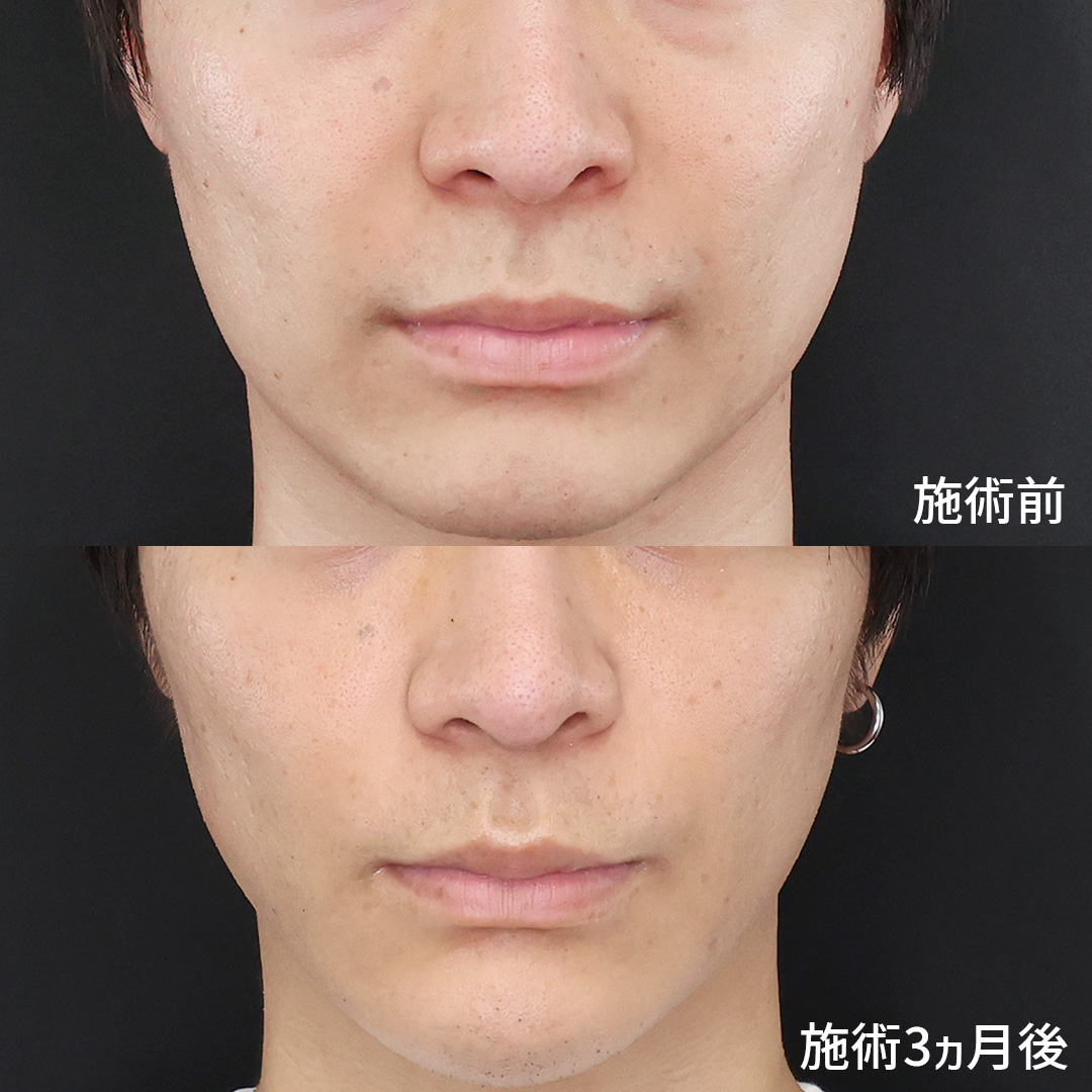ほうれい線のヒアルロン酸注射の症例写真 施術前後 20代男性　3カ月経過　正面