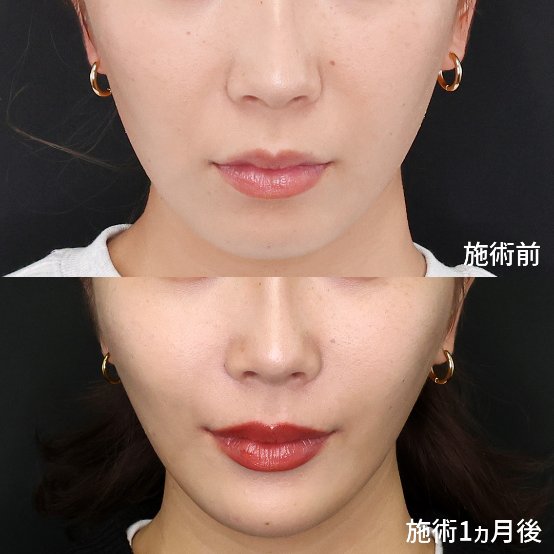 ほうれい線のヒアルロン酸注射の症例写真 施術前後 20代女性　1カ月経過　正面