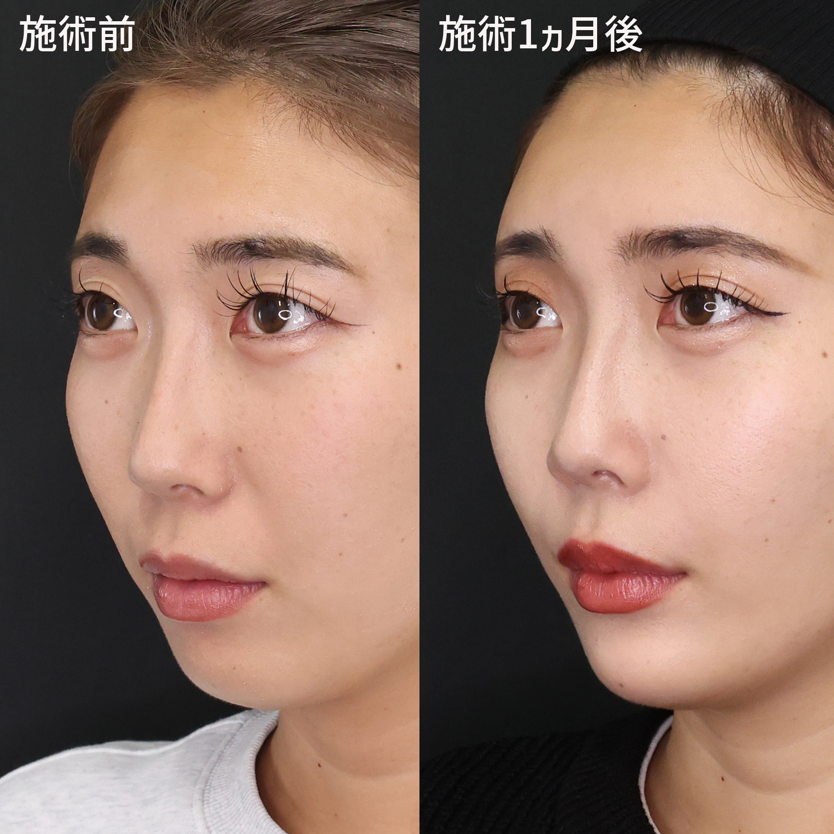 ほうれい線のヒアルロン酸注射の症例写真 施術前後 20代女性　1カ月経過　斜め