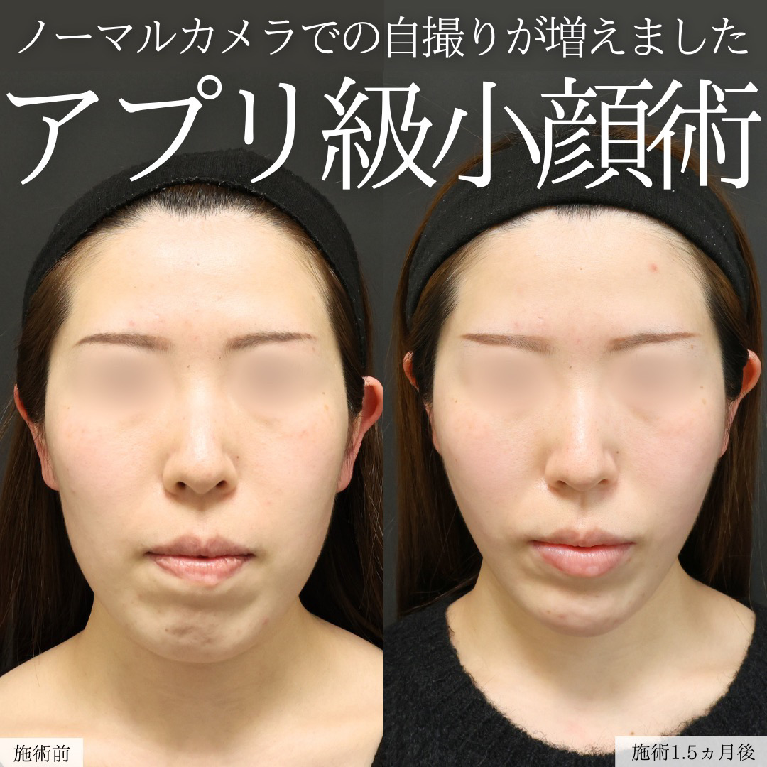 TAC式 ツヤ肌コラーゲンリフト®/ジョールファット除去/顎下の脂肪吸引の症例写真 施術前後 