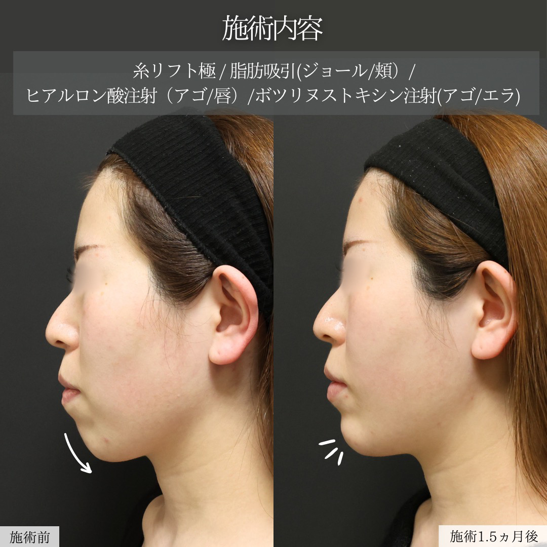 TAC式 ツヤ肌コラーゲンリフト®/ジョールファット除去/顎下の脂肪吸引の症例写真 施術前後 