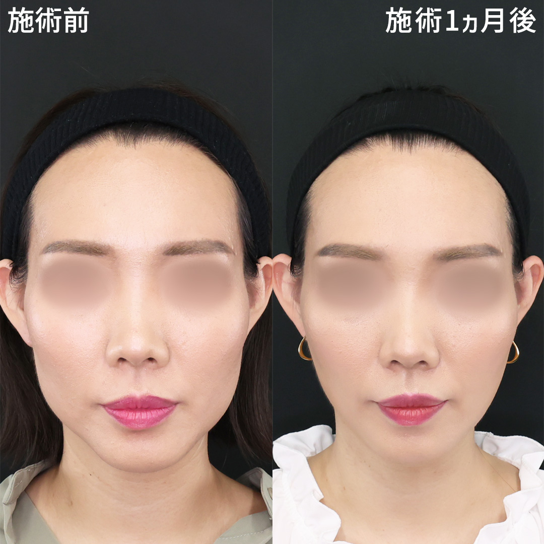 TAC式 ツヤ肌コラーゲンリフト®/エラボトックス注射/眉間のしわ取りボトックス注射の症例写真 施術前後 