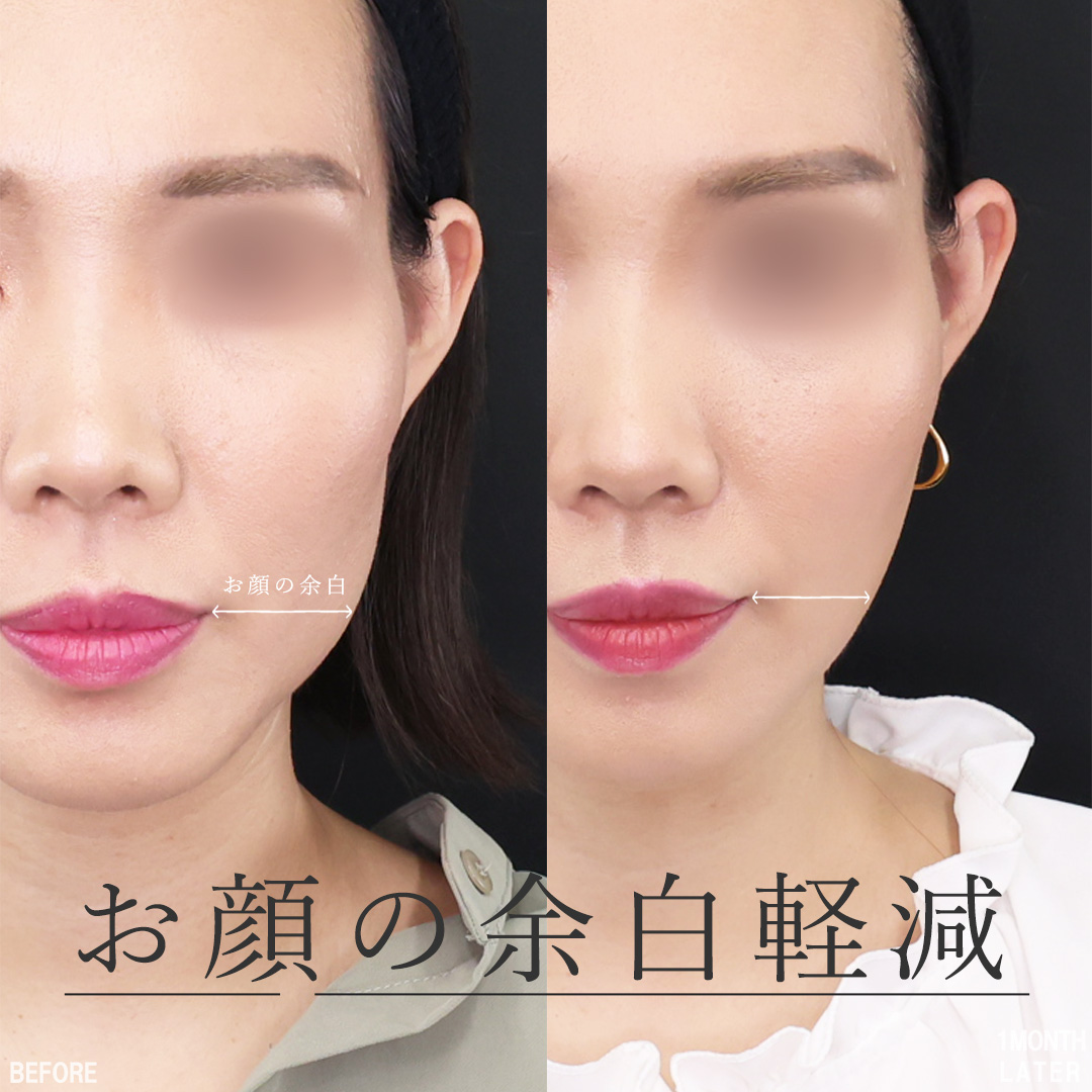 TAC式 ツヤ肌コラーゲンリフト®/エラボトックス注射/眉間のしわ取りボトックス注射の症例写真 施術前後 