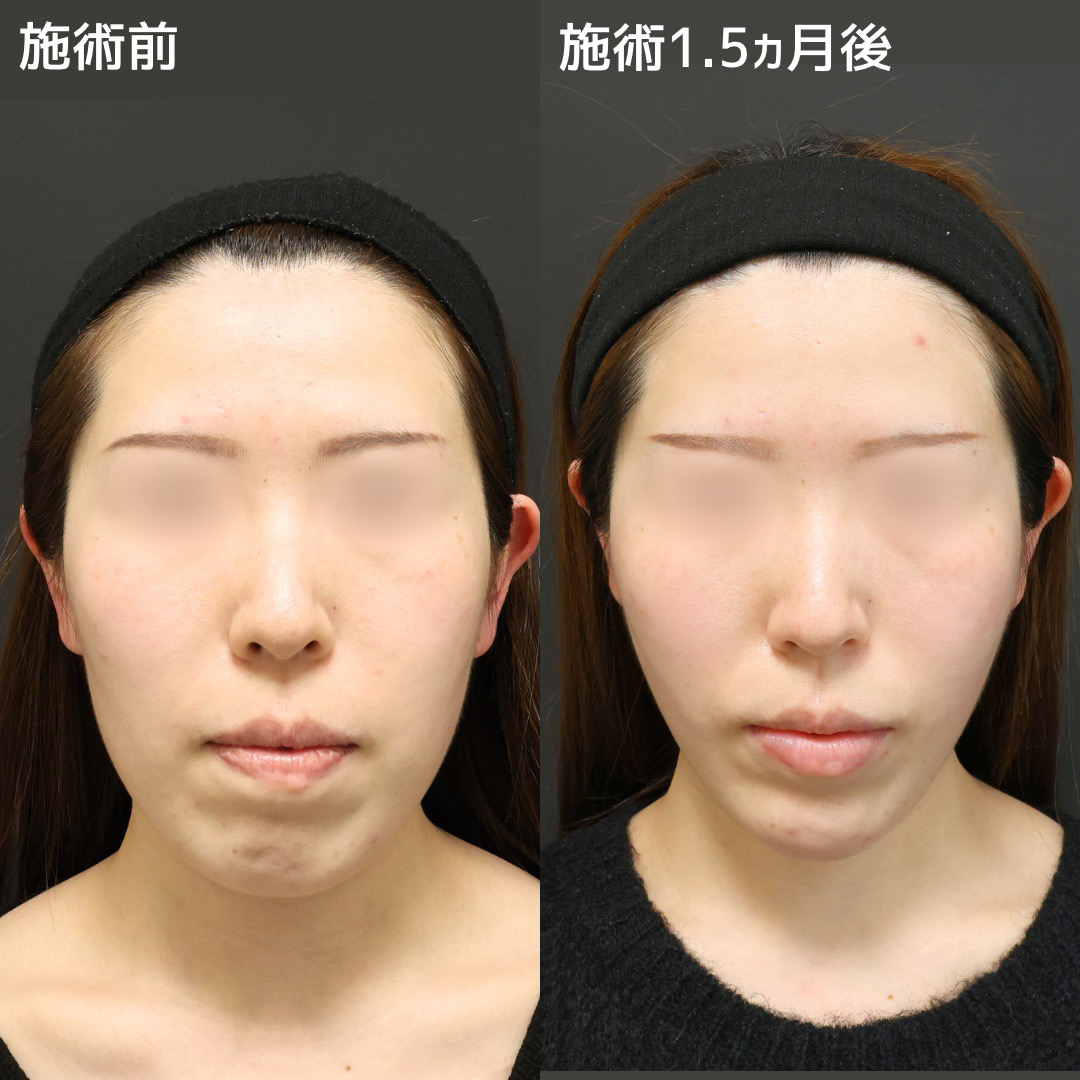 TAC式 ツヤ肌コラーゲンリフト®/ジョールファット除去/顎下の脂肪吸引の症例写真 施術前後 