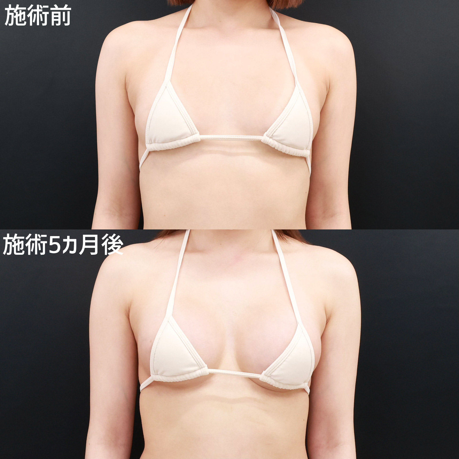 シリコンバッグ豊胸（人工乳腺バッグ）の症例写真 施術前後 