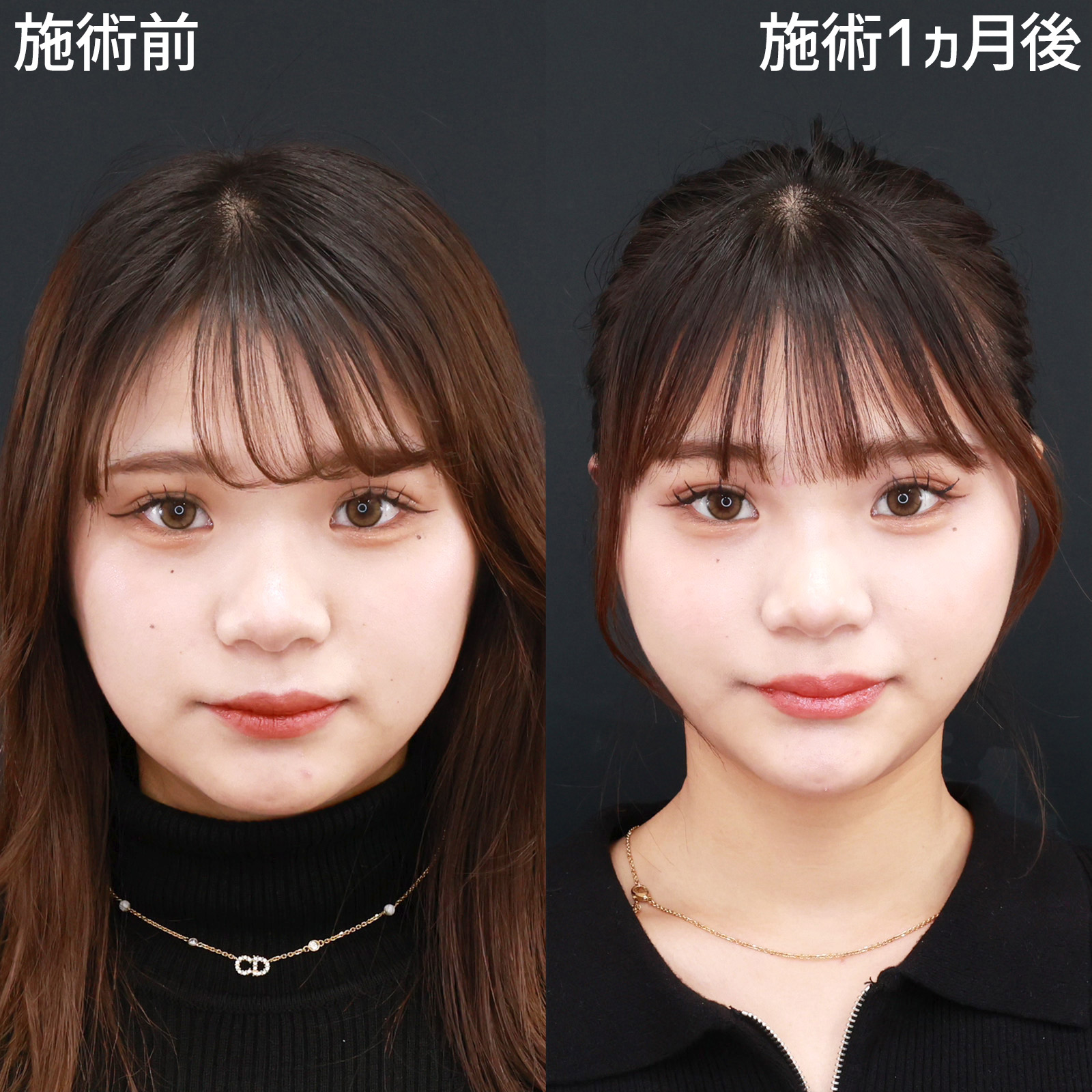 小顔整形 パーフェクトフェイスラインの症例写真 平松医師