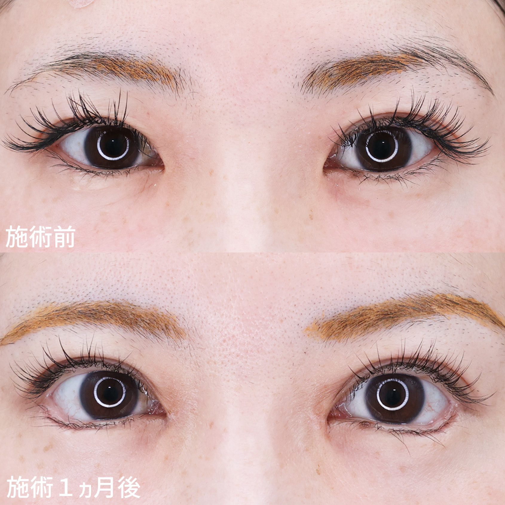 グラマラスライン（タレ目形成）/上眼瞼切開術/目頭切開術の症例写真 施術前後 