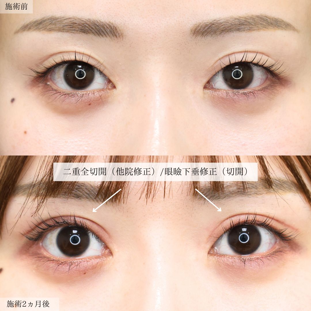二重切開（全切開法）/上眼瞼切開術/眼瞼下垂（目つき矯正）の症例写真 施術前後 
