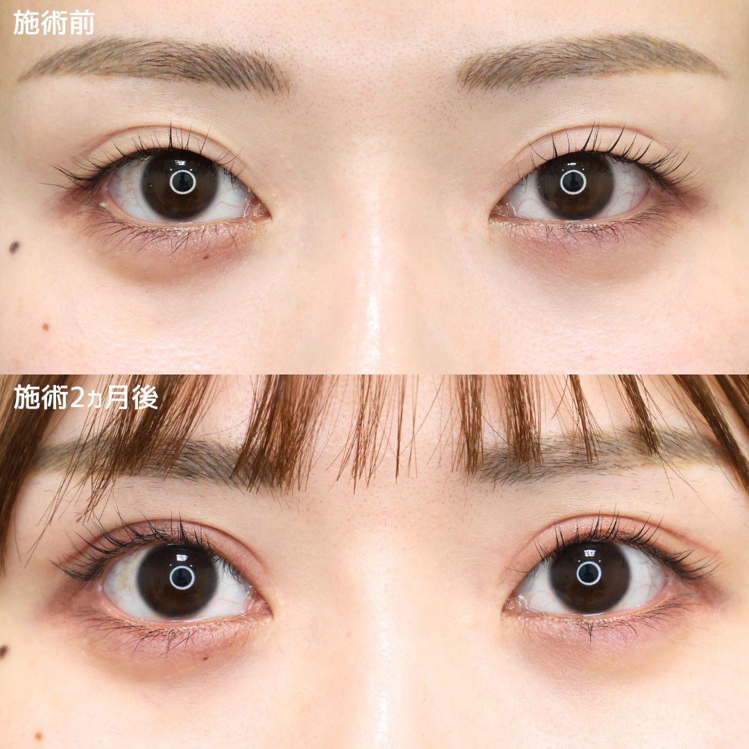 二重切開（全切開法）/上眼瞼切開術/眼瞼下垂（目つき矯正）の症例写真 施術前後 