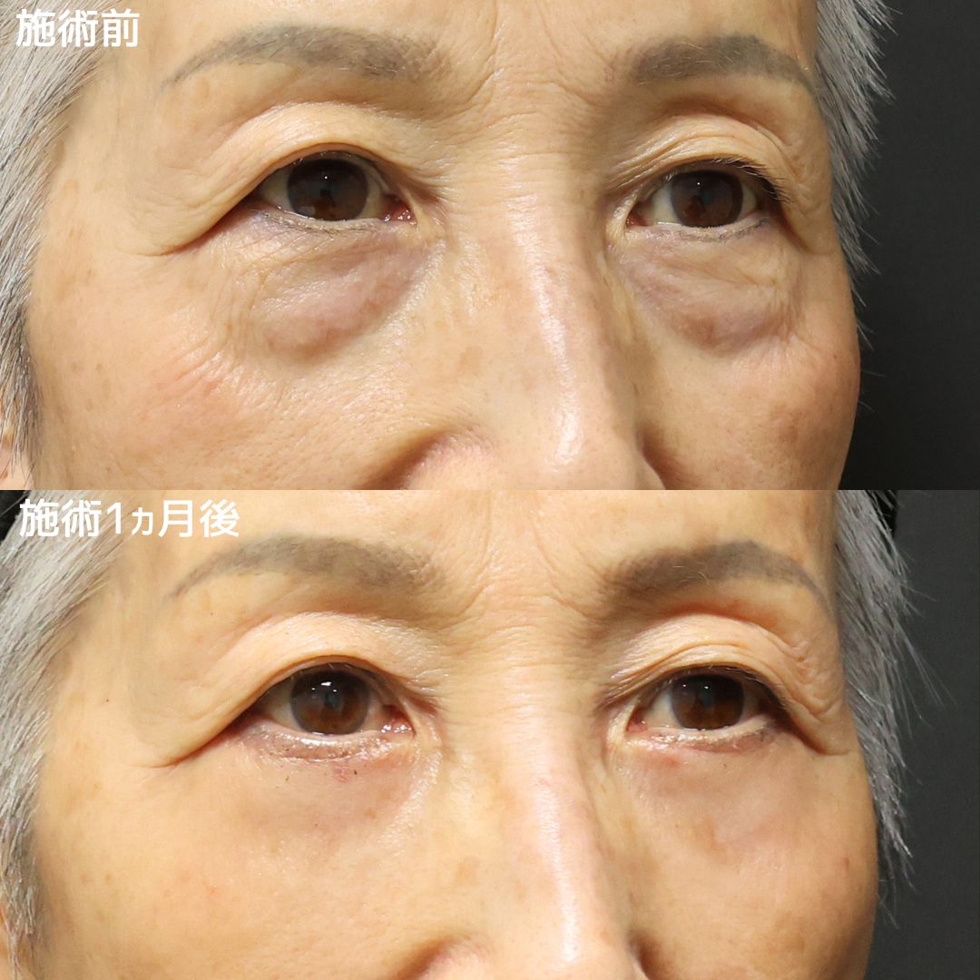 下眼瞼切開術（クマ・たるみとり）/下眼瞼脱脂術（目の下のたるみ取り・目の下の脂肪ふくらみ取り）/顔の脂肪注入(コンデンスリッチフェイス)の症例写真 施術前後 
