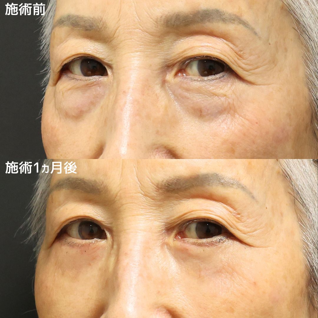 下眼瞼切開術（クマ・たるみとり）/下眼瞼脱脂術（目の下のたるみ取り・目の下の脂肪ふくらみ取り）/顔の脂肪注入(コンデンスリッチフェイス)の症例写真 施術前後 