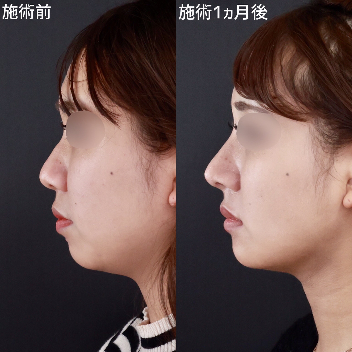 鼻尖形成・鼻尖縮小/鼻先軟骨移植/鼻中隔延長術の症例写真 施術前後 